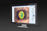 EyeSuite IOL Toric Planner