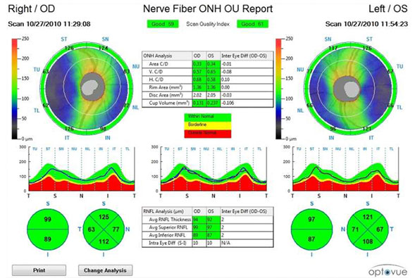 iVue and iFusion Nerve Fiber Report
